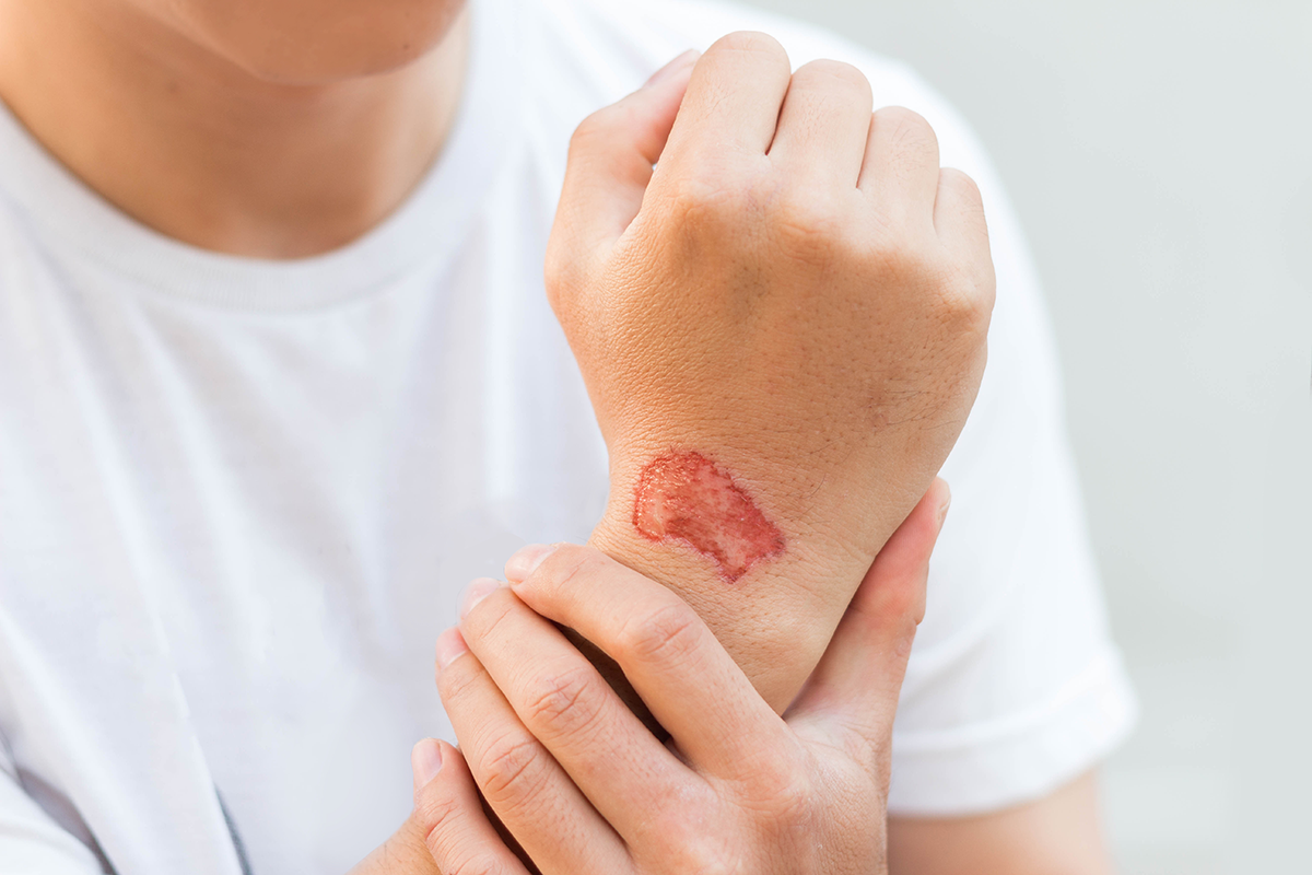 Communicable Skin Infections