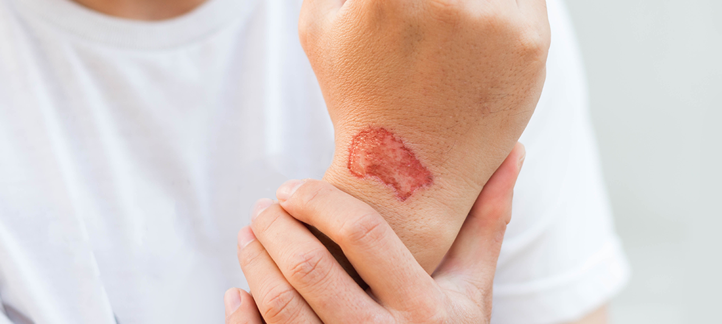 Communicable Skin Infections